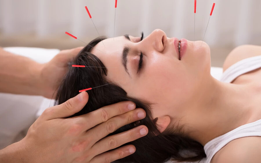 Arc akupunktúra: az arc akupunktúra egy olyan technika, amely során apró, steril tűket szúrnak az arc meghatározott pontjaiba. Ez a kezelés serkenti a kollagéntermelést, javítja a vérkeringést, és csökkenti a finom vonalak és ráncok megjelenését. A rendszeres kezelések segíthetnek a bőr rugalmasságának fokozásában, és fiatalosabb és ragyogóbb megjelenést kölcsönözhetnek az arcnak.